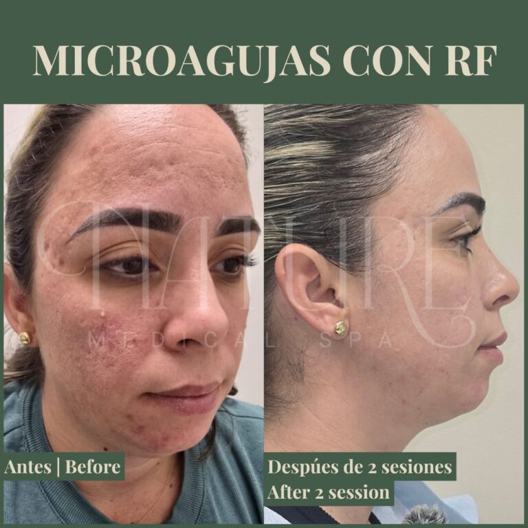 advanced-rf-microneedling