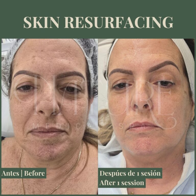 advanced-skin-resurfacing-miami