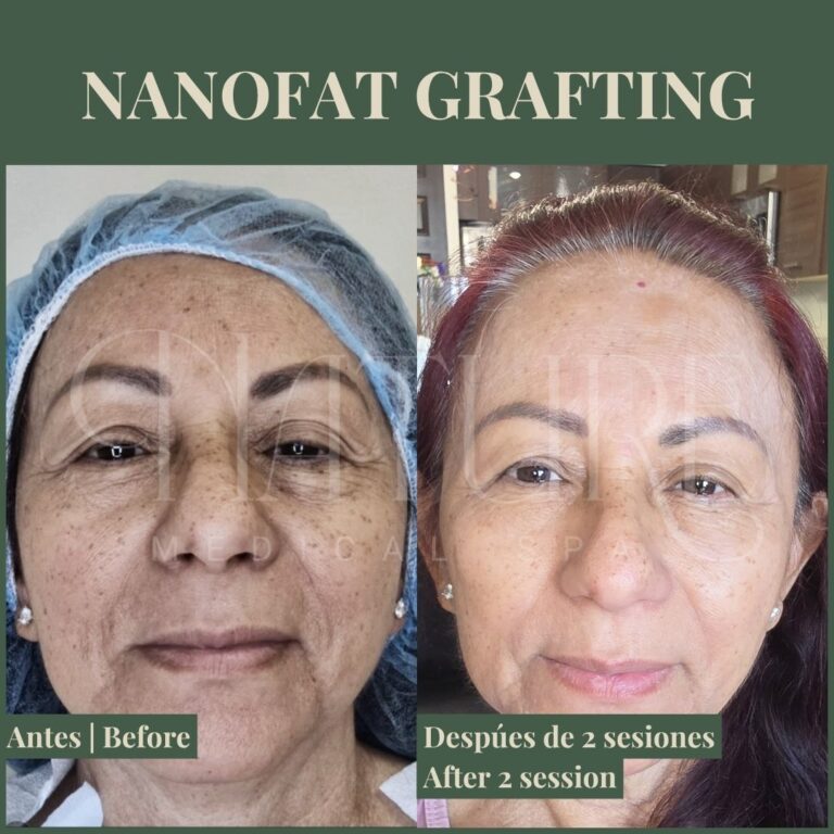 facial-fat-transfer-miami