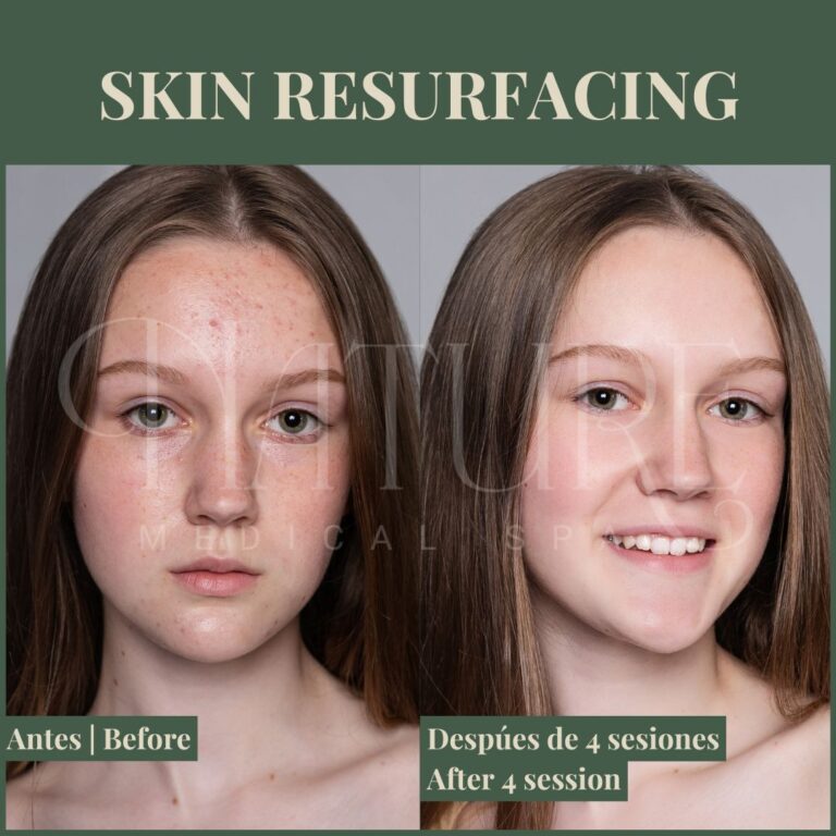 facial-skin-resurfacing-procedure