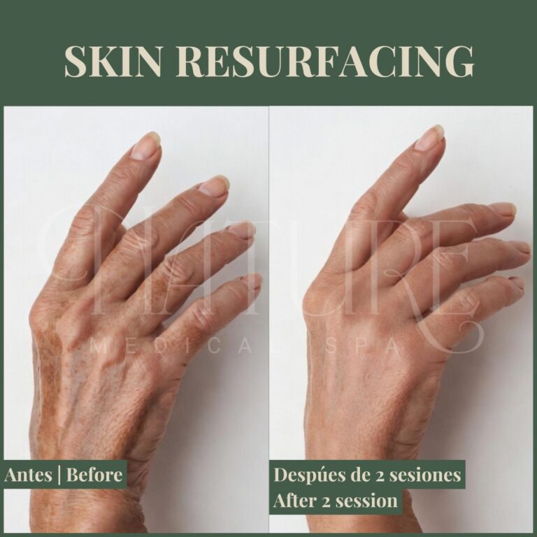 fractional-laser-skin-resurfacing-miami