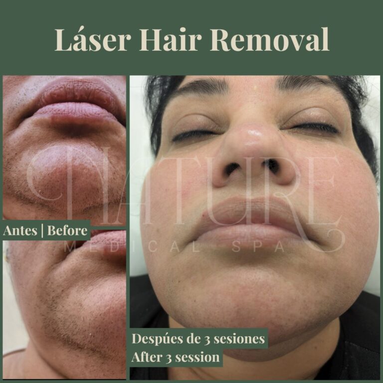 laser-hair-removal-treatment-miami