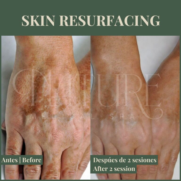 laser-skin-resurfacing-results