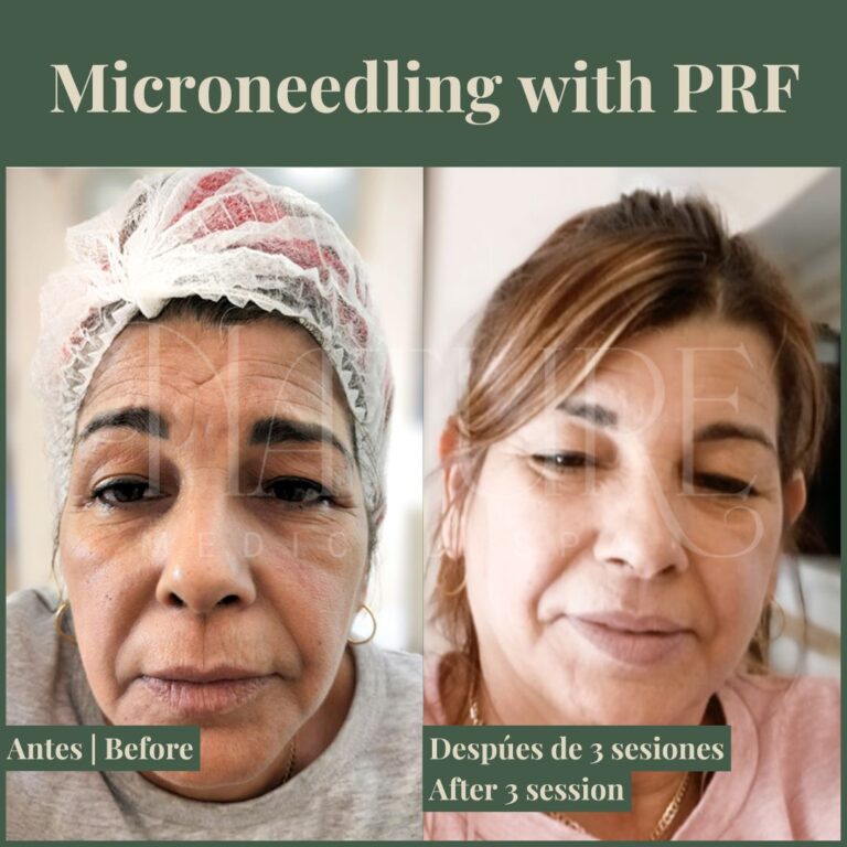 microneedling-with-prf-treatment-miami