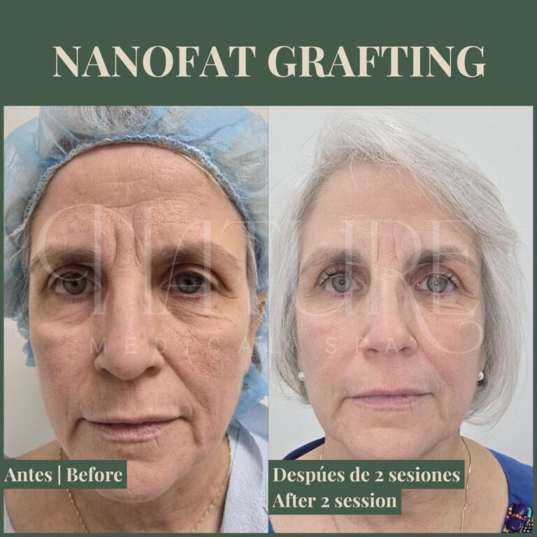nanofat-facial-rejuvenation
