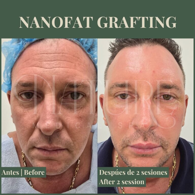 nanofat-grafting-miami