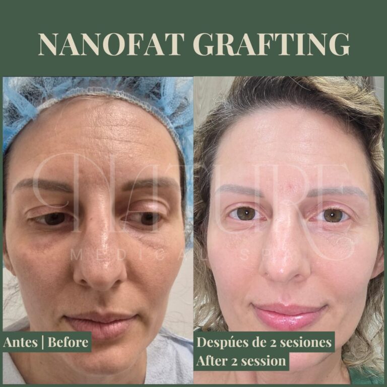 nanofat-under-eye-treatment