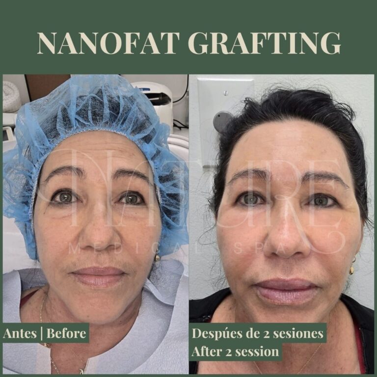 natural-fat-grafting-fac