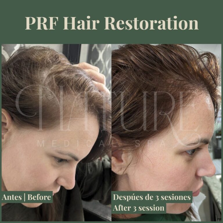 natural-hair-restoration-prf