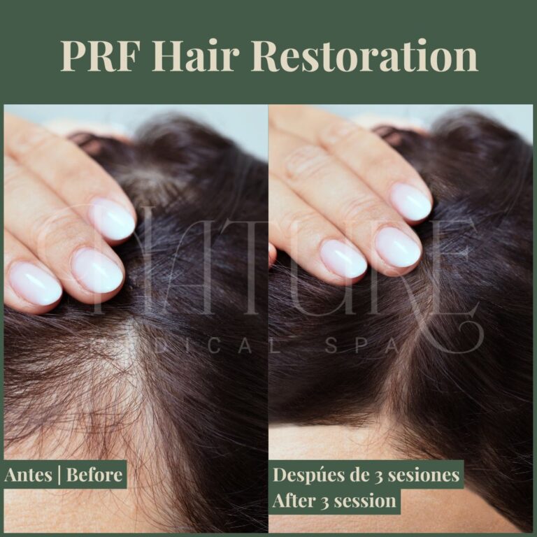 platelet-rich-fibrin-hair-restoration
