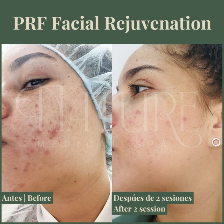 prf-facial-rejuvenation-miami