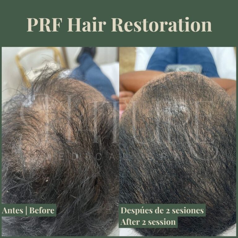 prf-hair-restoration-miami