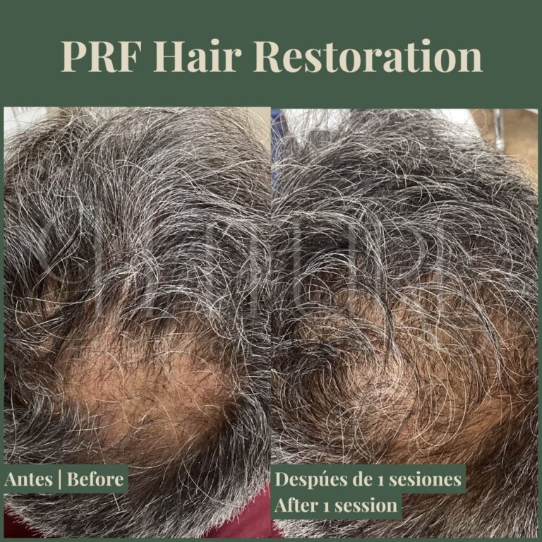 prf-scalp-treatment
