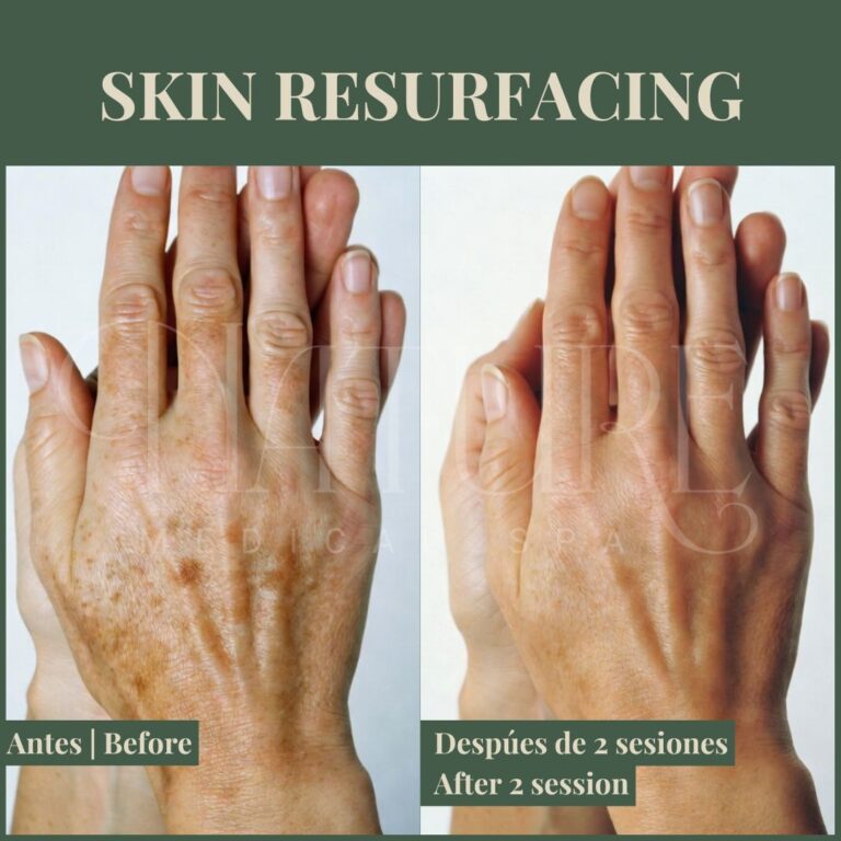 professional-skin-resurfacing