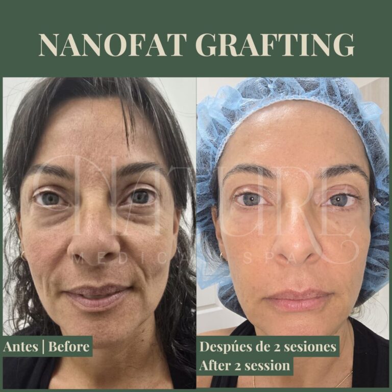 regenerative-nanofat-treatment