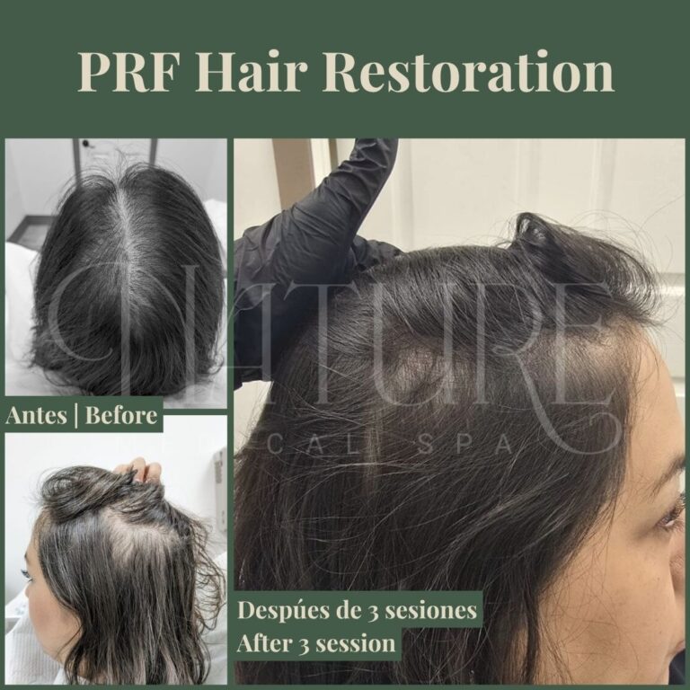 regenerative-prf-hair-treatment