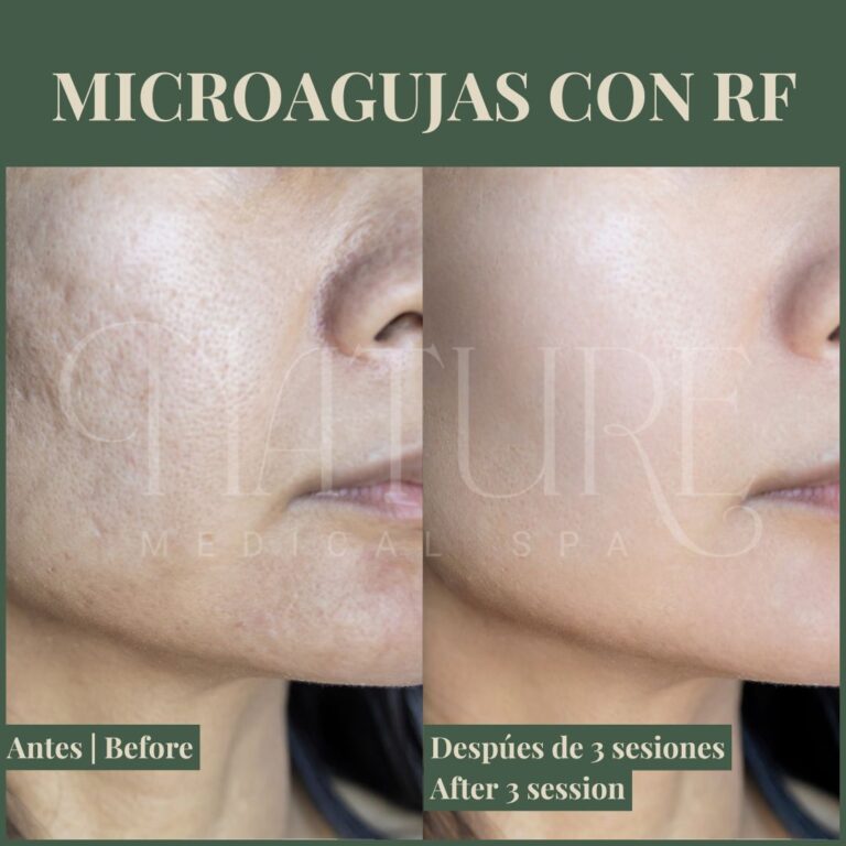rf-microneedling-skin-rejuvenation