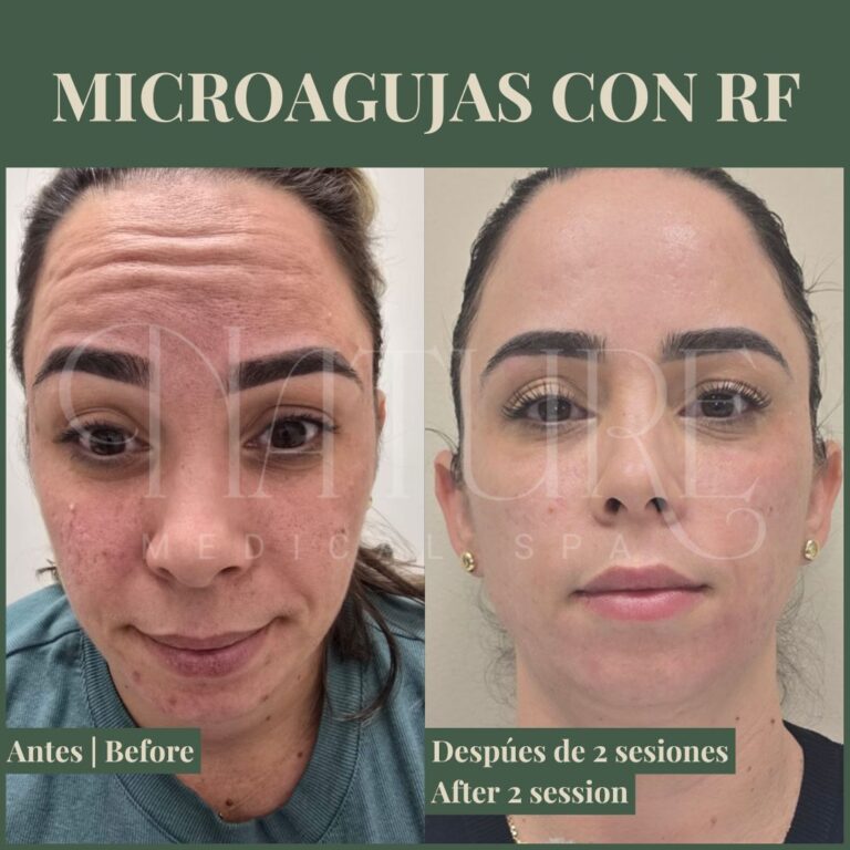 rf-microneedling-treatment-miami