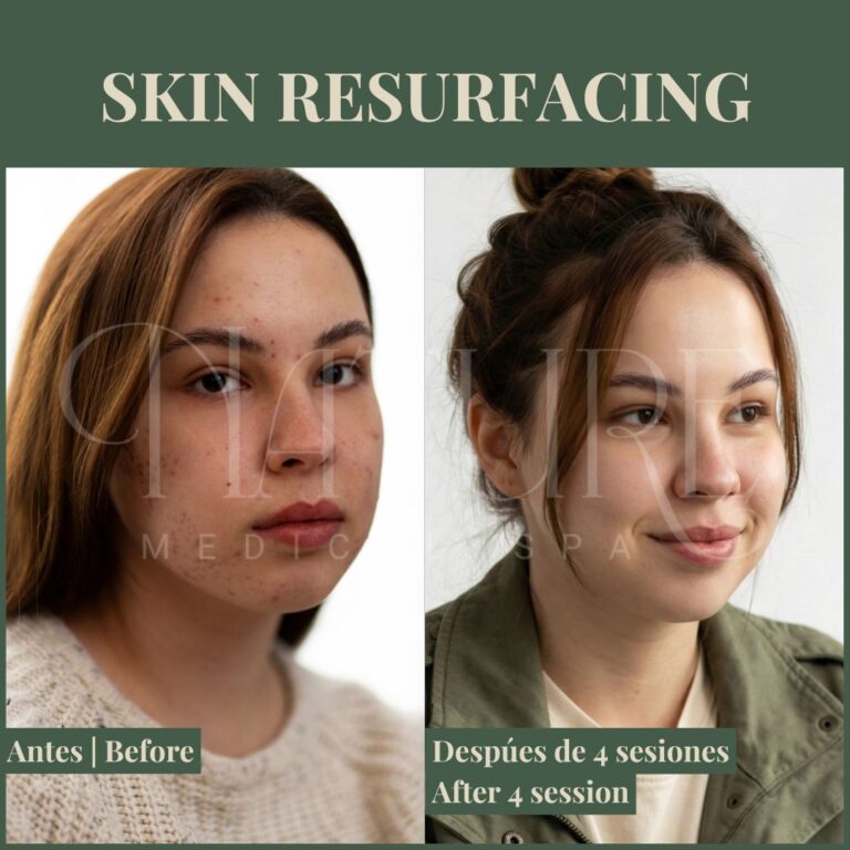 skin-renewal-treatment-miami