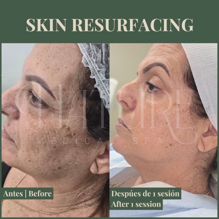 skin-resurfacing-treatment-miami