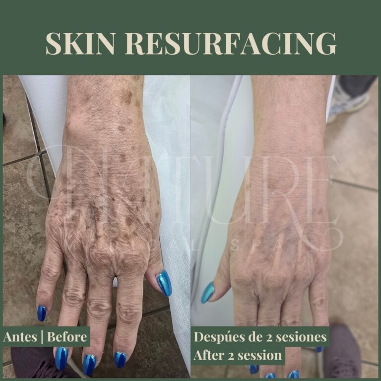 skin-texture-improvement-miami